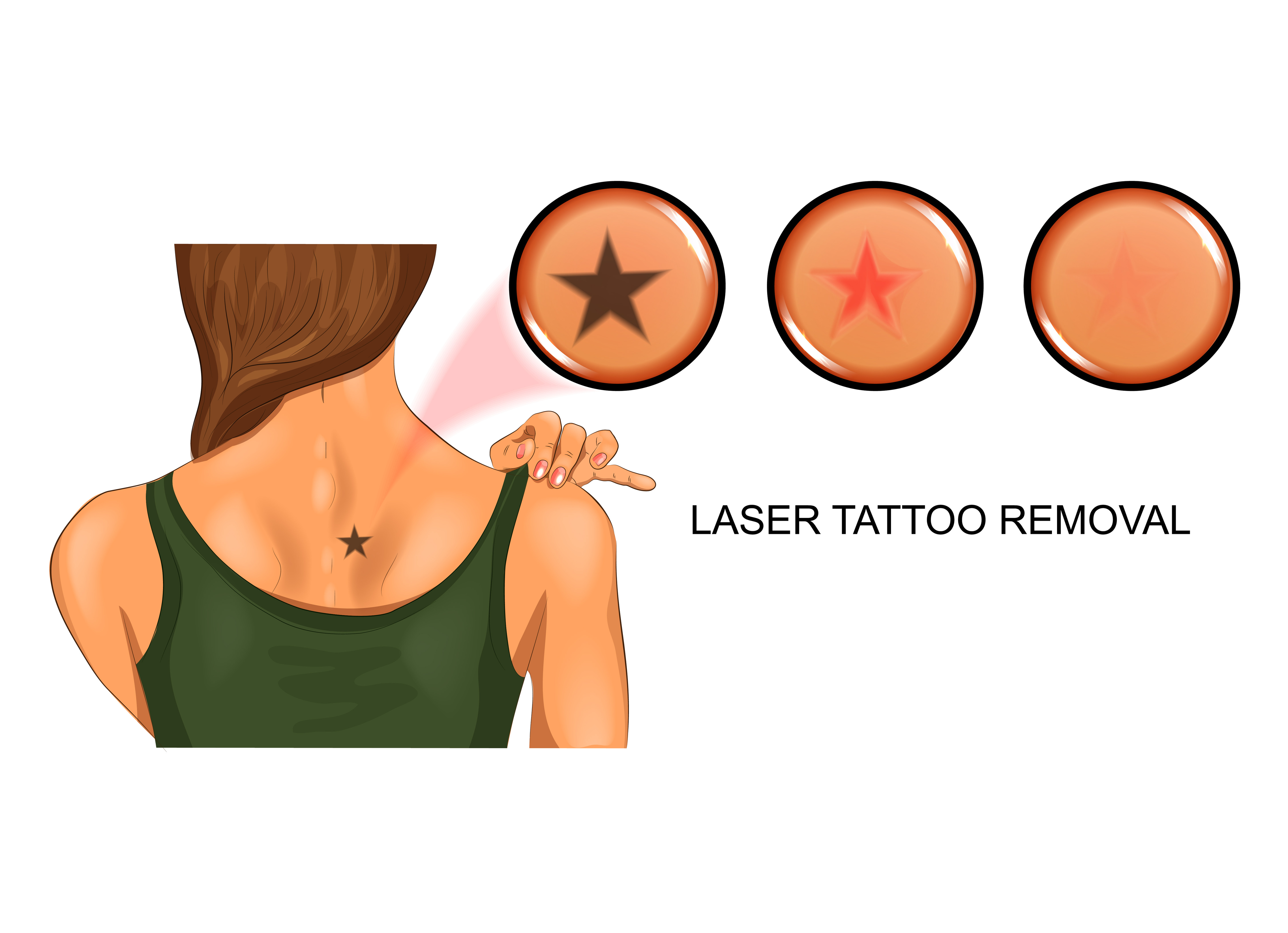 Laser Tattoo Removal vs Dermabrasion Tattoo Removal  WIFH